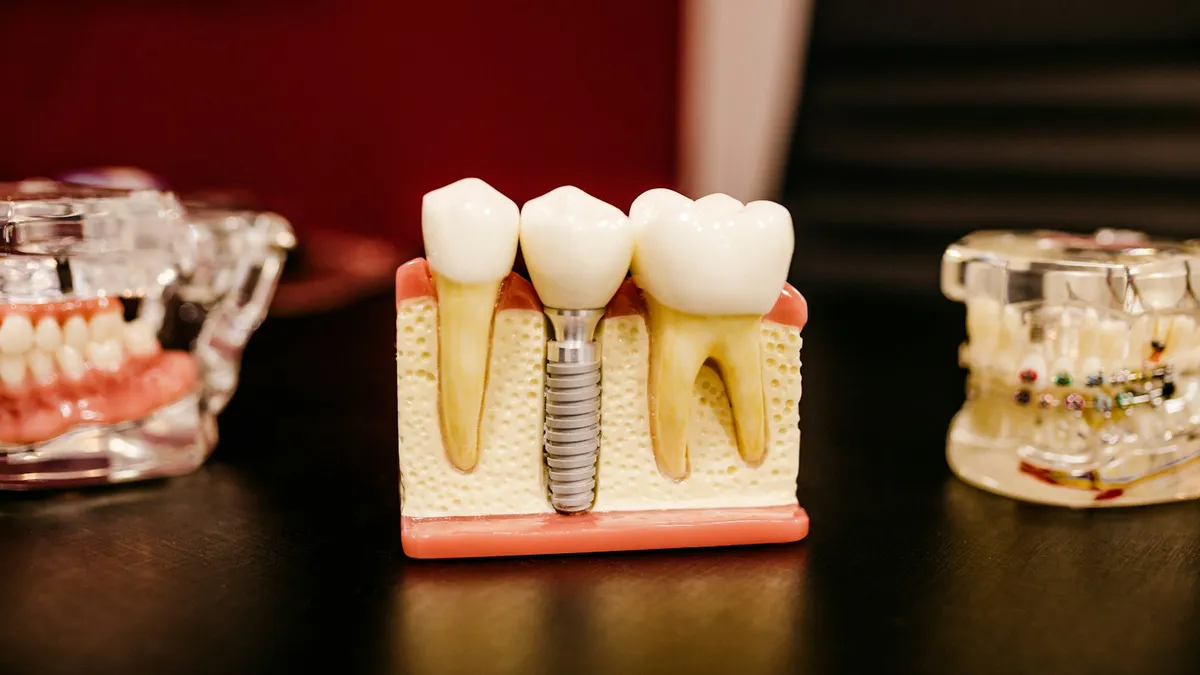 All-on-4 vs. Snap-In Dentures Cost: 2026 Northern California Investment Guide