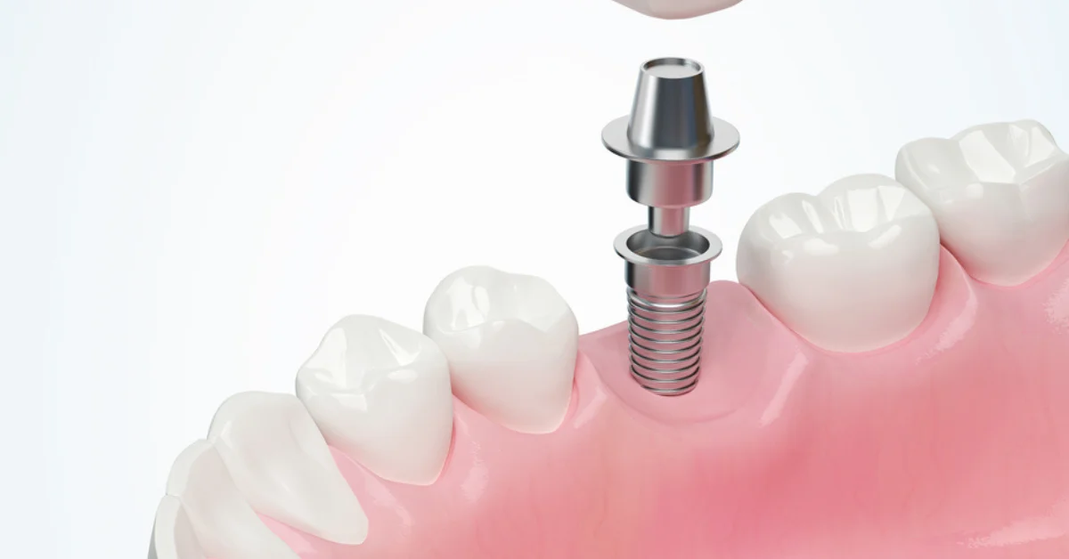 Dental Crowns and Bridges in Roseville and El Dorado Hills