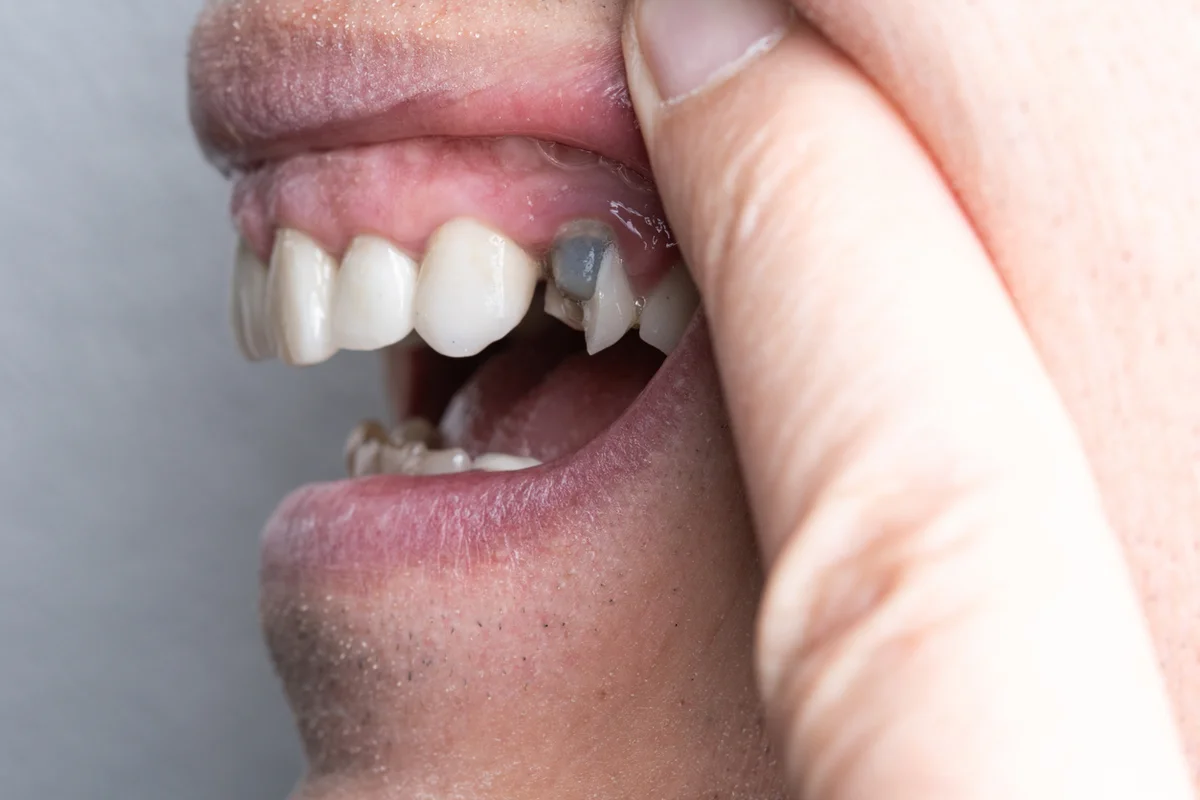 Dental Implant Infection Signs: When to Call Your Dentist