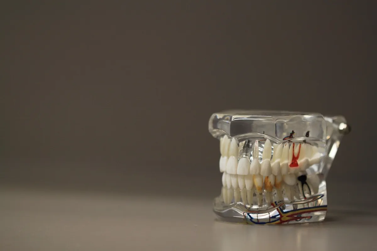 What Are Dental Implants? Everything You Need to Know