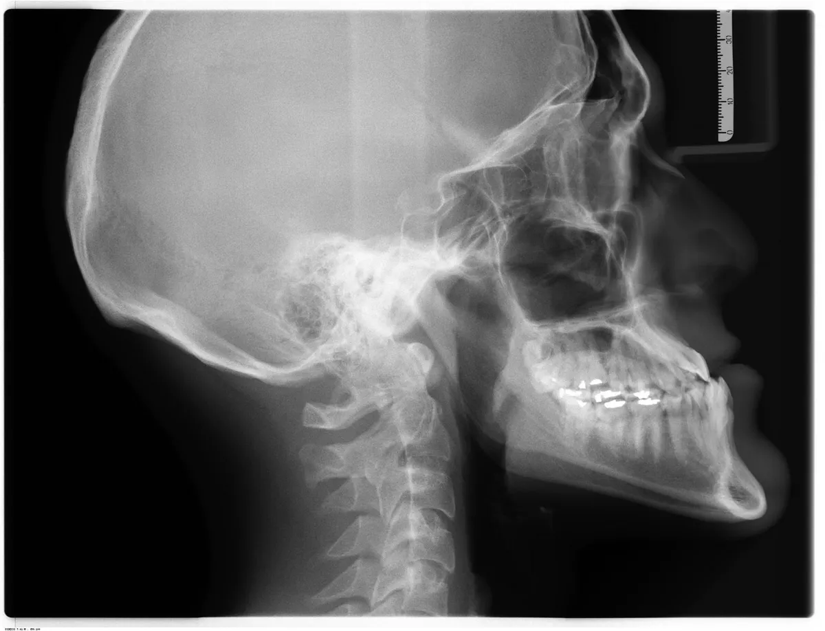 Zygomatic Implants: When Traditional Implants Fail