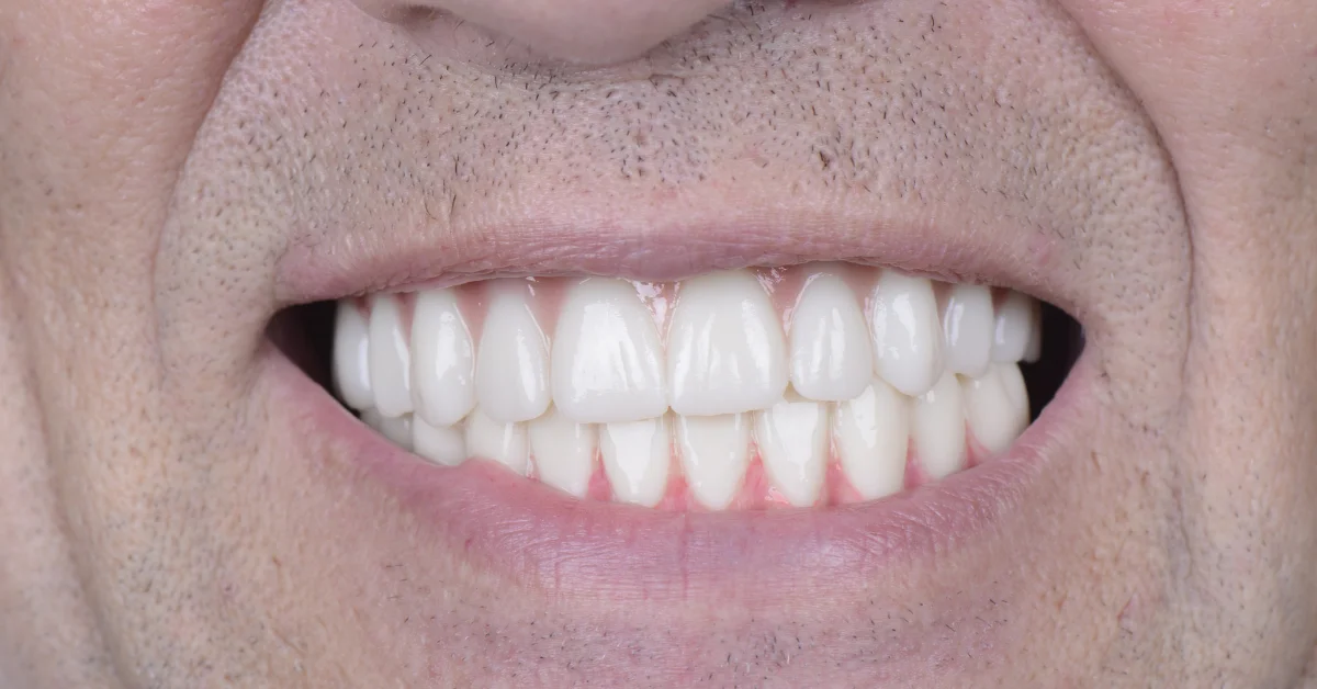 Soft Food Diet After Dental Implants: What to Eat and Avoid