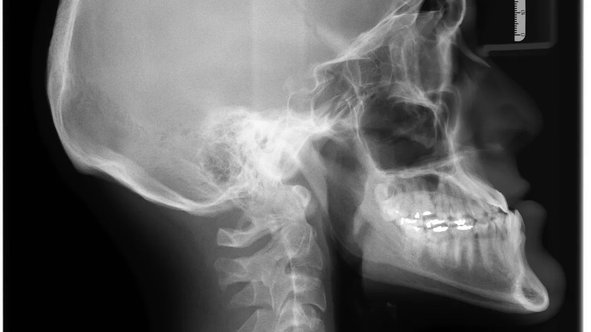 Why Dental Implants Fail Years Later