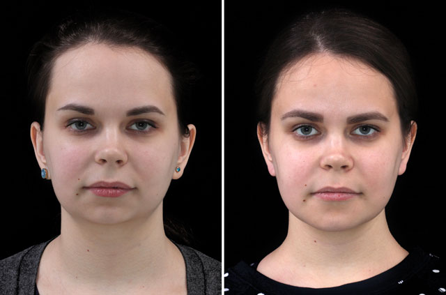 Class II Occlusion Asymmetric Deformity Jaw Surgery