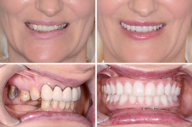 Immediate Implants and Teeth All-On-4 Surgical Case
