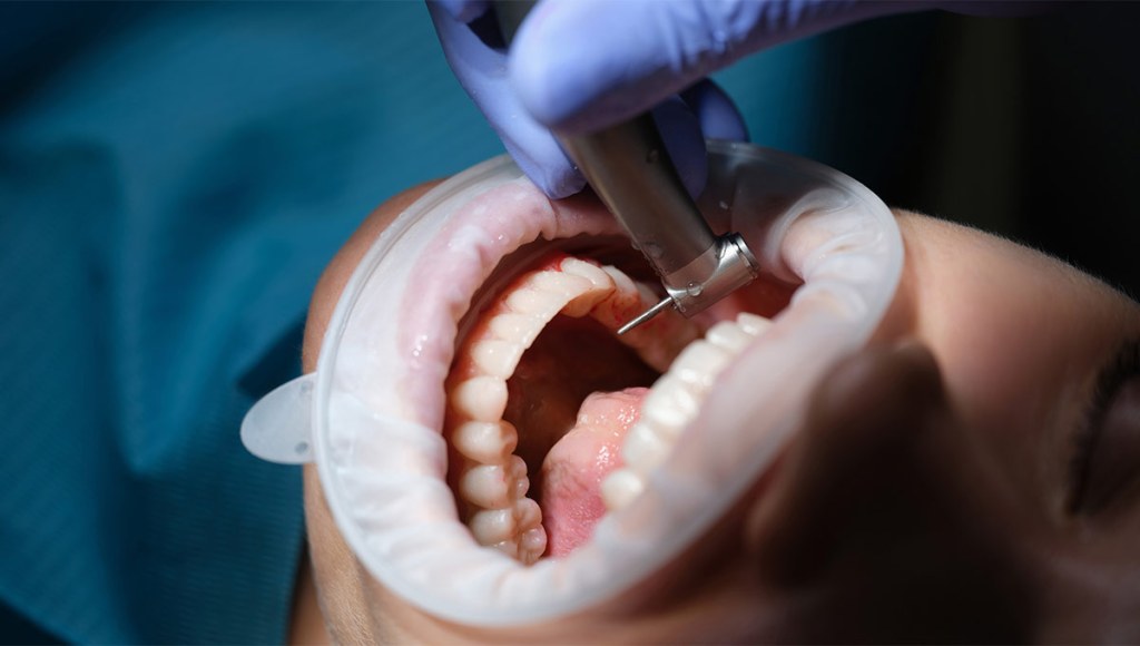 Debunking Common Myths About Dental Implants