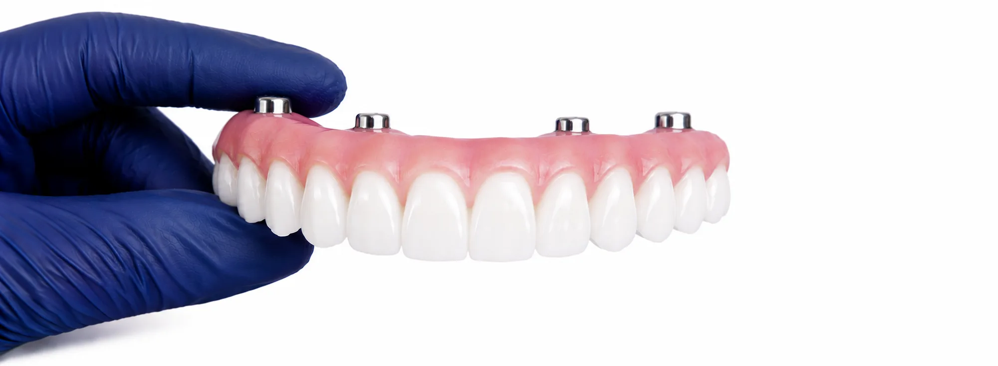 Full Mouth Dental Implants in California: Costs, Regional Pricing, and How to Choose