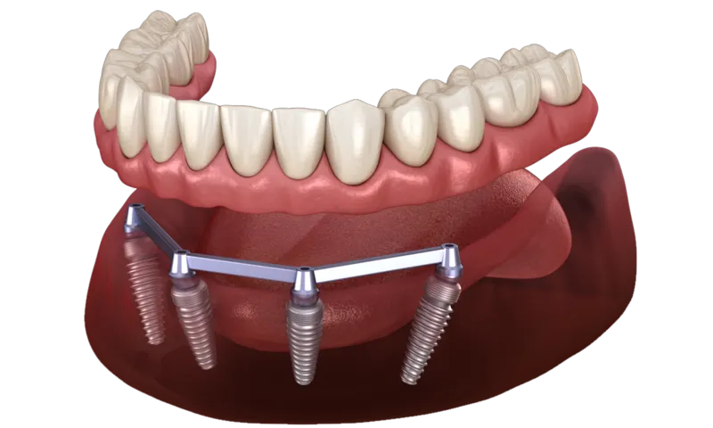 How Many Implants Do You Need for Implant-Supported Dentures? 2 vs 4 vs 6 Explained