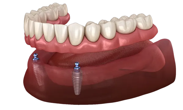 Snap-In Dentures in El Dorado Hills: Local Costs, Process, and What to Expect