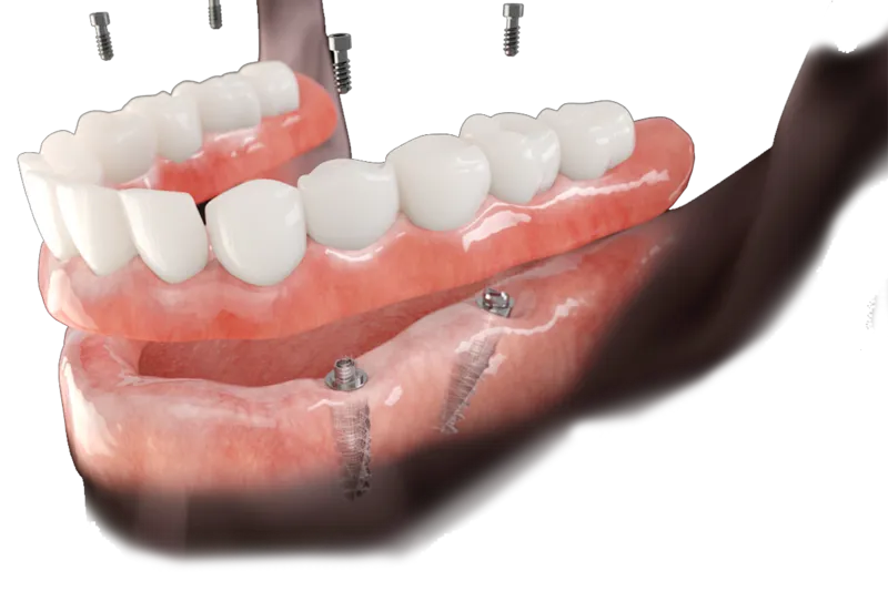 Types of Permanent Dental Implants: Which Kind Fits Your Case?