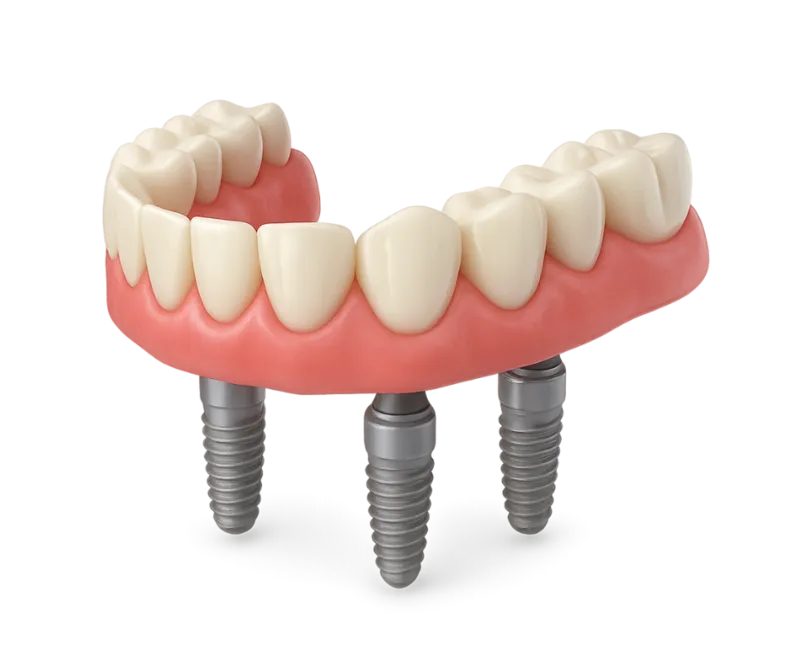 Full-Arch Implants