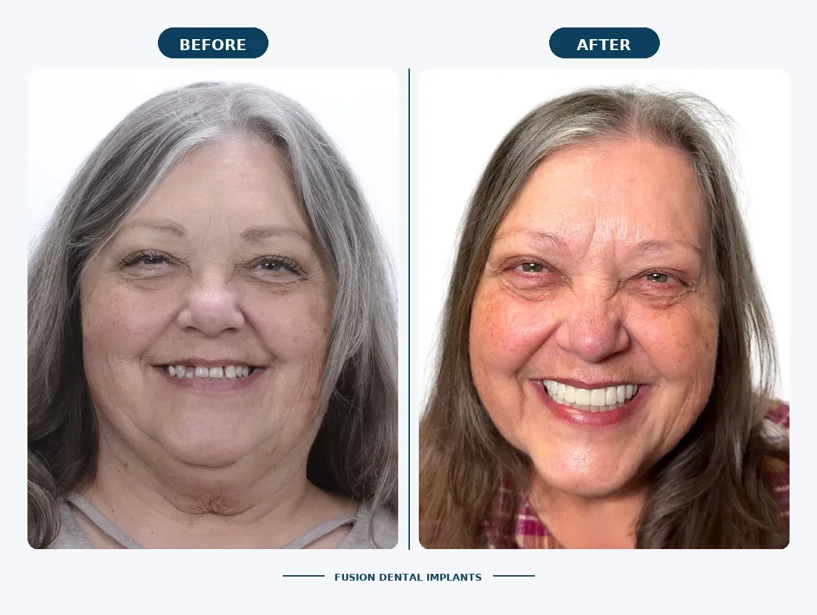 How All-on-4 Dental Implants Change Your Face: Bone, Structure, and a Younger Look