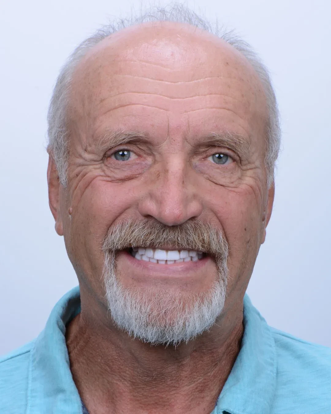 After - Dental implant transformation - life-changing results