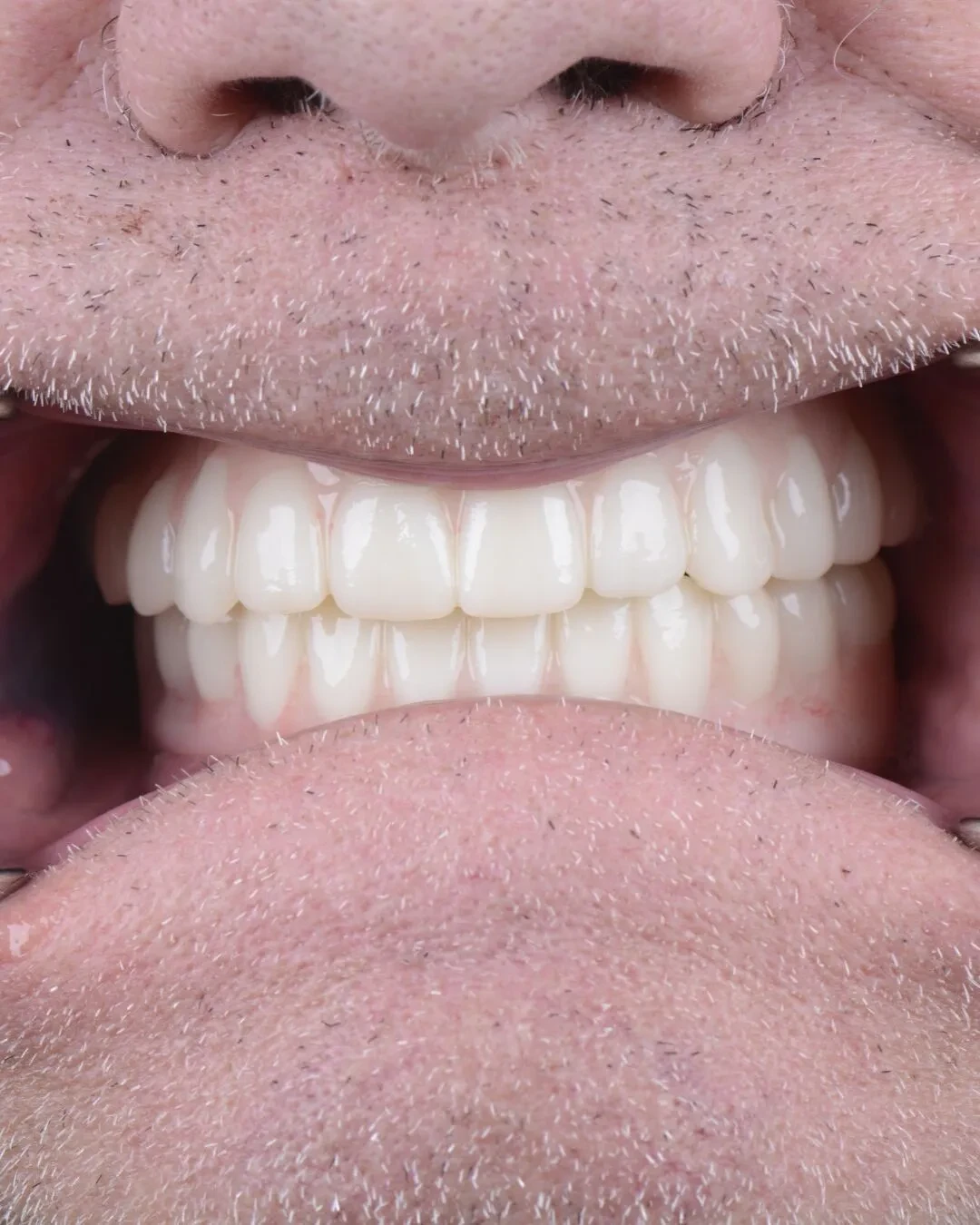 Close-up of patient 4 teeth after implant restoration