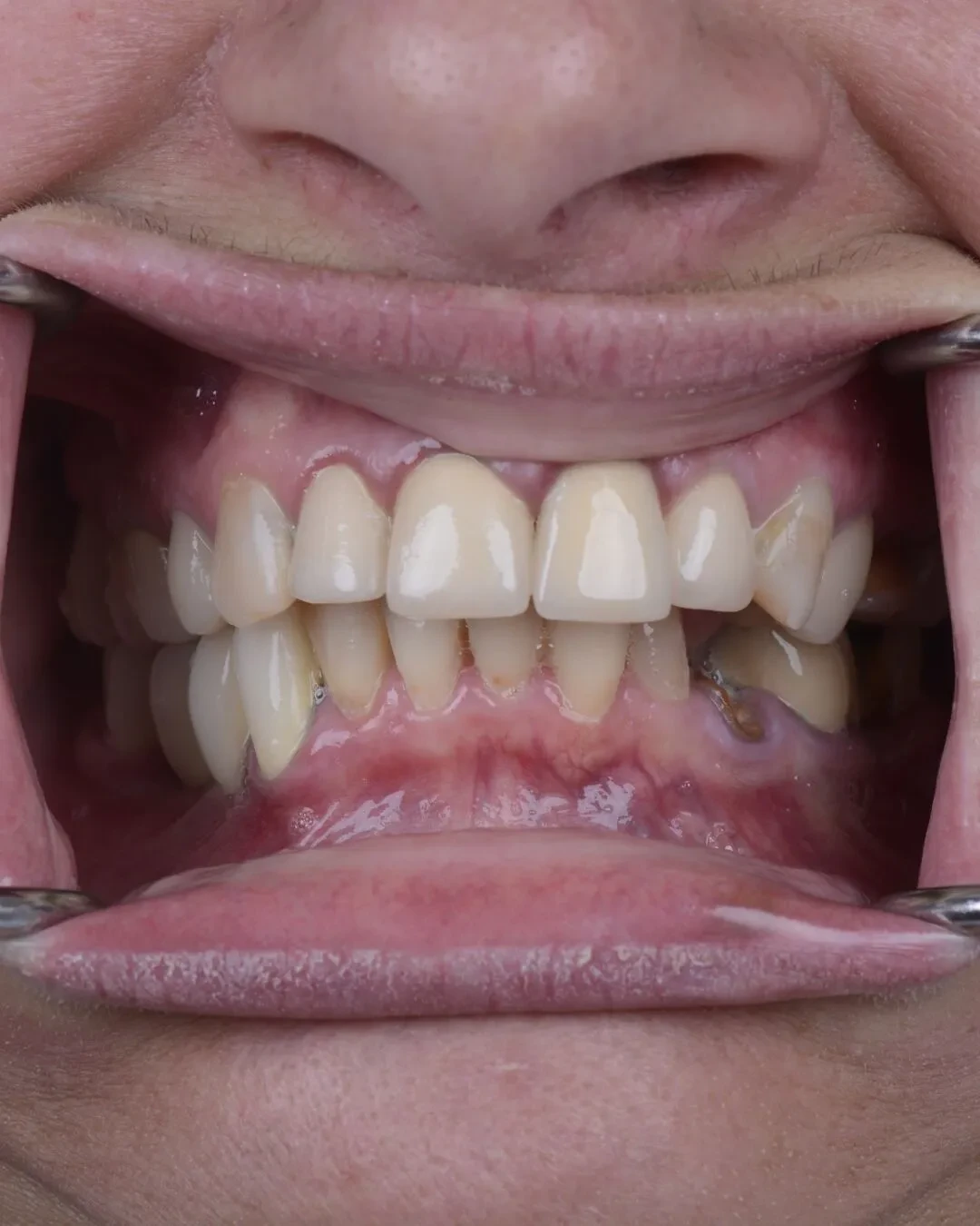 Before teeth close-up - Dental implant transformation - beautiful new smile